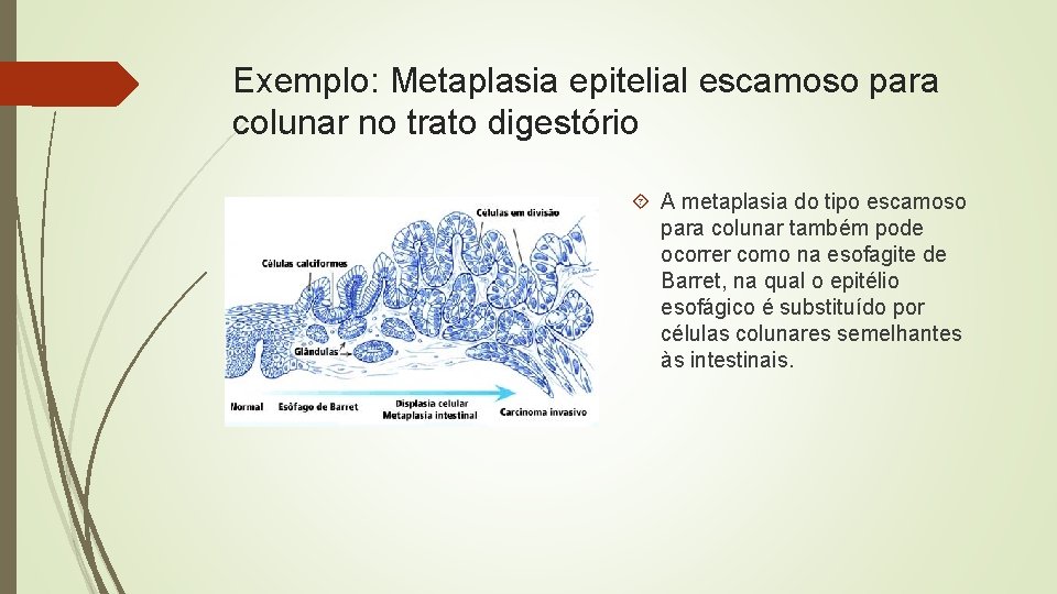 Exemplo: Metaplasia epitelial escamoso para colunar no trato digestório A metaplasia do tipo escamoso
