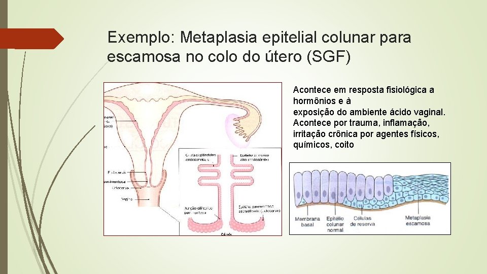 Exemplo: Metaplasia epitelial colunar para escamosa no colo do útero (SGF) Acontece em resposta