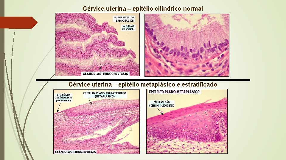 Cérvice uterina – epitélio cilíndrico normal Cérvice uterina – epitélio metaplásico e estratificado 