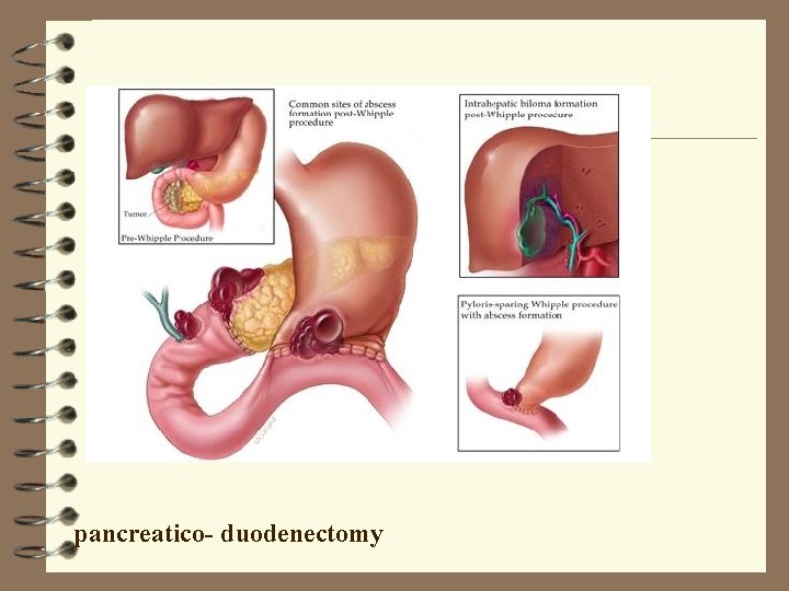 pancreatico- duodenectomy 