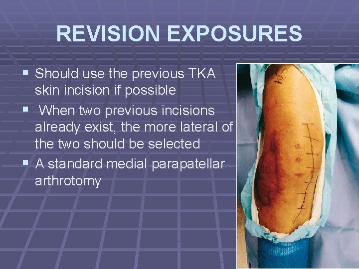 REVISION EXPOSURES § Should use the previous TKA skin incision if possible § When