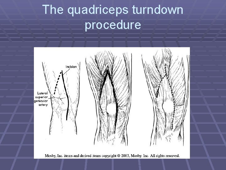 The quadriceps turndown procedure 