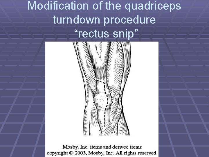 Modification of the quadriceps turndown procedure “rectus snip” 
