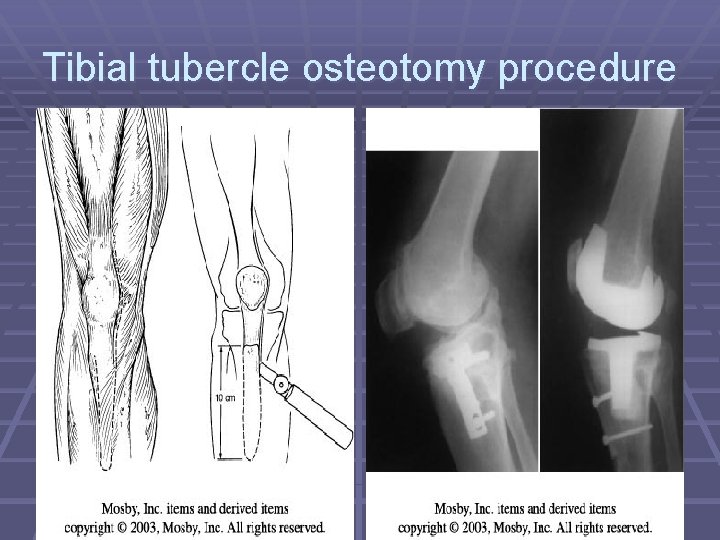 Tibial tubercle osteotomy procedure Tibial tubercle osteotomy procedure