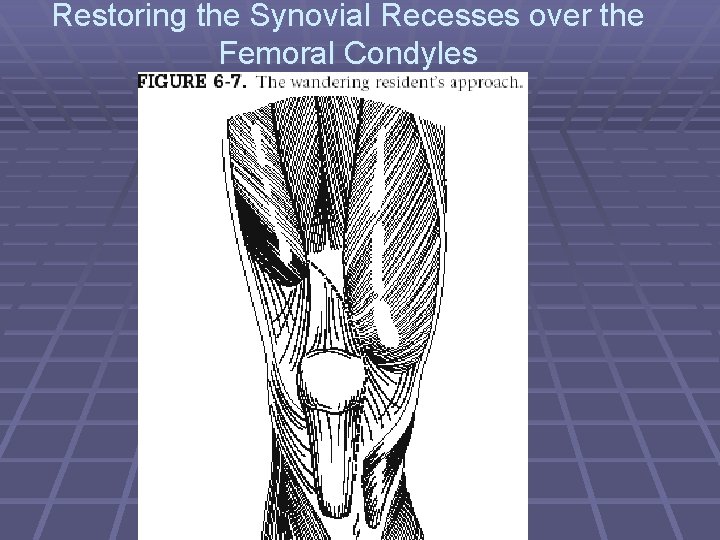 Restoring the Synovial Recesses over the Femoral Condyles 