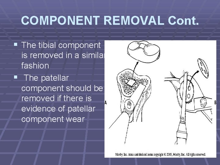 COMPONENT REMOVAL Cont. § The tibial component is removed in a similar fashion § COMPONENT REMOVAL Cont. § The tibial component is removed in a similar fashion §