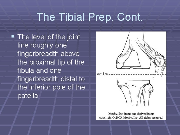 The Tibial Prep. Cont. § The level of the joint line roughly one fingerbreadth