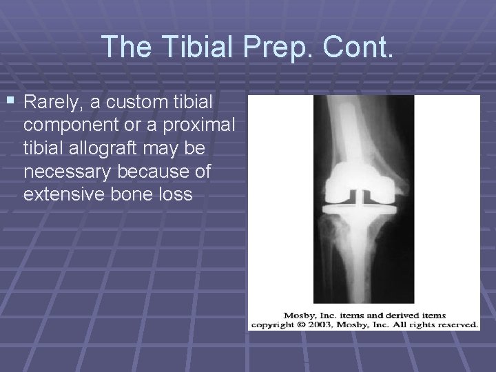 The Tibial Prep. Cont. § Rarely, a custom tibial component or a proximal tibial