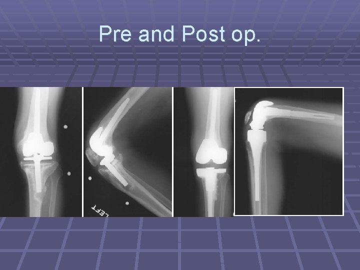 Pre and Post op. Pre and Post op.