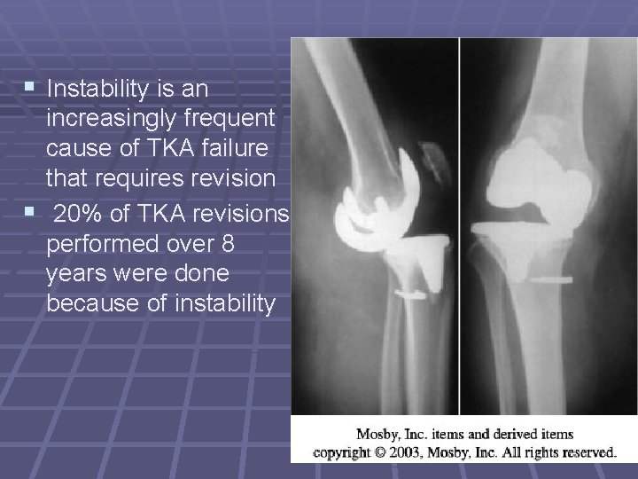 § Instability is an increasingly frequent cause of TKA failure that requires revision §