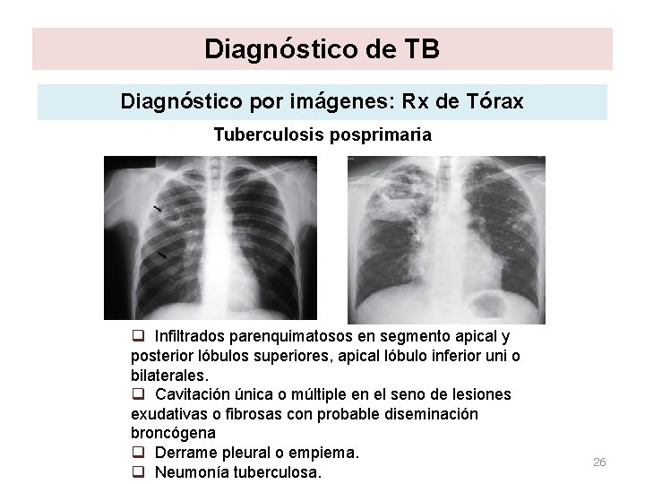 Diagnóstico de TB Diagnóstico por imágenes: Rx de Tórax Tuberculosis posprimaria q Infiltrados parenquimatosos Diagnóstico de TB Diagnóstico por imágenes: Rx de Tórax Tuberculosis posprimaria q Infiltrados parenquimatosos