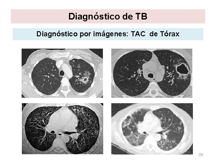Diagnóstico de TB Diagnóstico por imágenes: TAC de Tórax 28 Diagnóstico de TB Diagnóstico por imágenes: TAC de Tórax 28