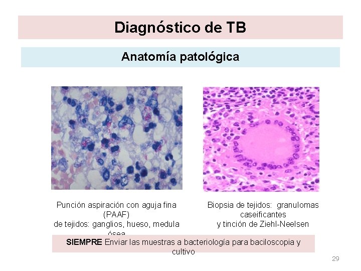 Diagnóstico de TB Anatomía patológica Punción aspiración con aguja fina Biopsia de tejidos: granulomas Diagnóstico de TB Anatomía patológica Punción aspiración con aguja fina Biopsia de tejidos: granulomas