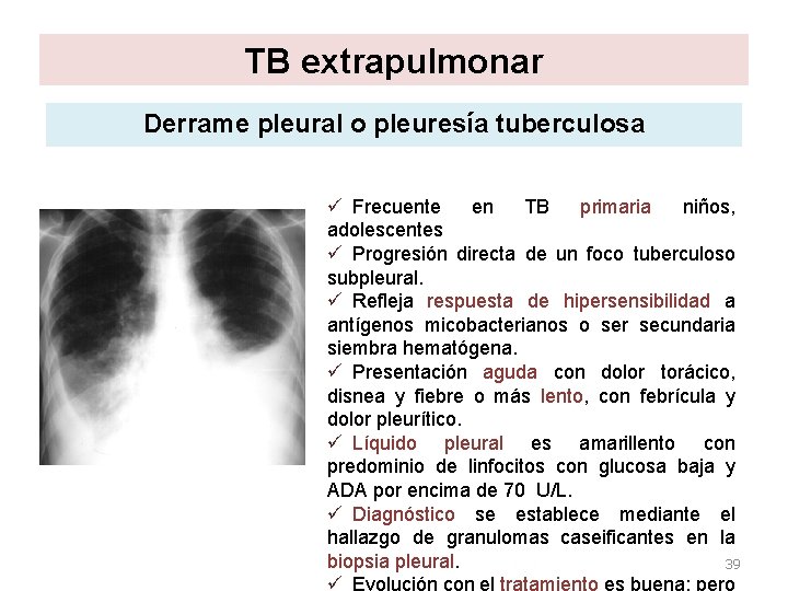 TB extrapulmonar Derrame pleural o pleuresía tuberculosa ü Frecuente en TB primaria niños, adolescentes TB extrapulmonar Derrame pleural o pleuresía tuberculosa ü Frecuente en TB primaria niños, adolescentes
