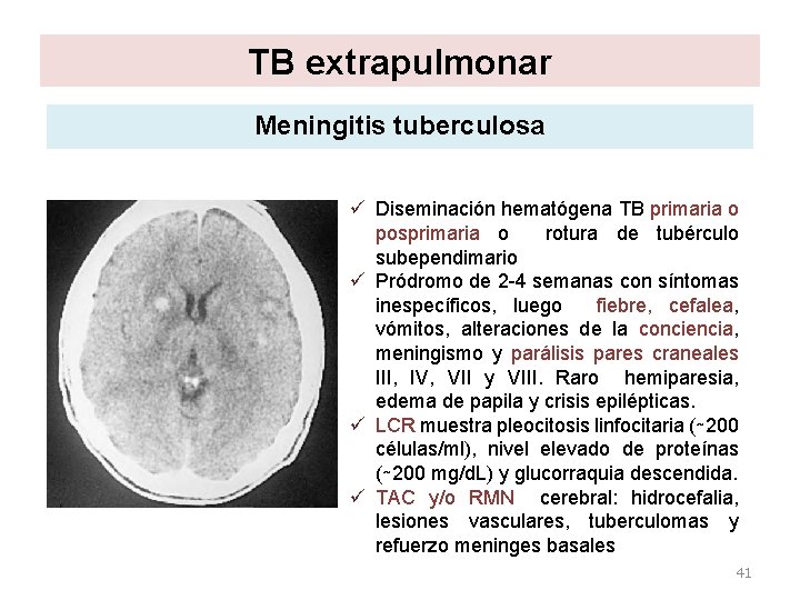 TB extrapulmonar Meningitis tuberculosa ü Diseminación hematógena TB primaria o posprimaria o rotura de TB extrapulmonar Meningitis tuberculosa ü Diseminación hematógena TB primaria o posprimaria o rotura de