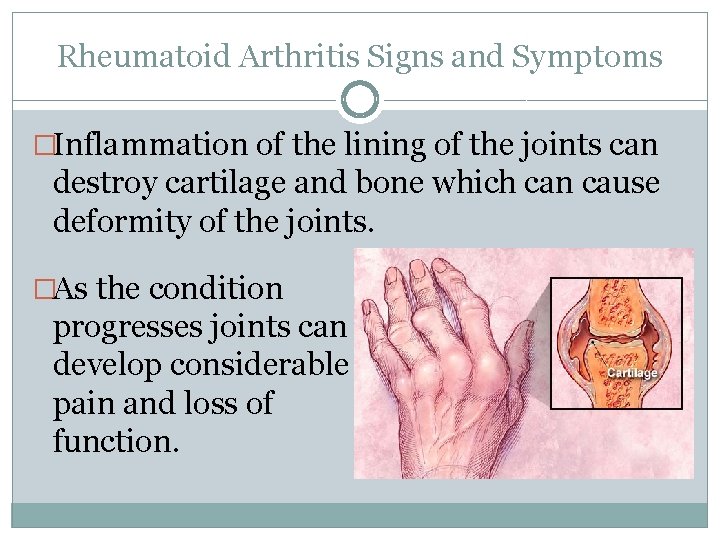 Rheumatoid Arthritis Signs and Symptoms �Inflammation of the lining of the joints can destroy