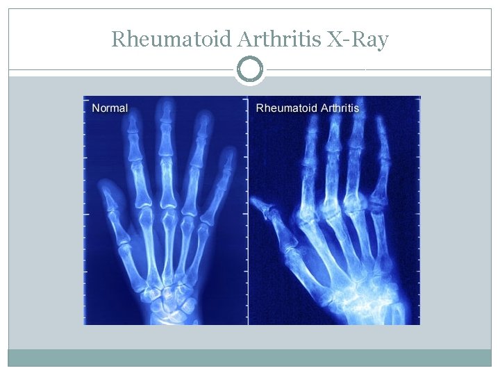 Rheumatoid Arthritis X-Ray 