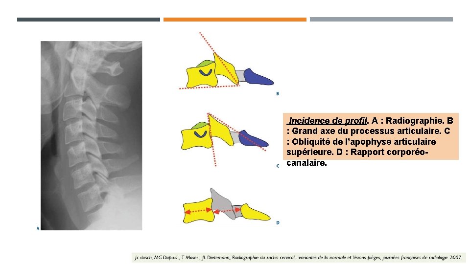 Incidence de profil. A : Radiographie. B : Grand axe du processus articulaire. C Incidence de profil. A : Radiographie. B : Grand axe du processus articulaire. C