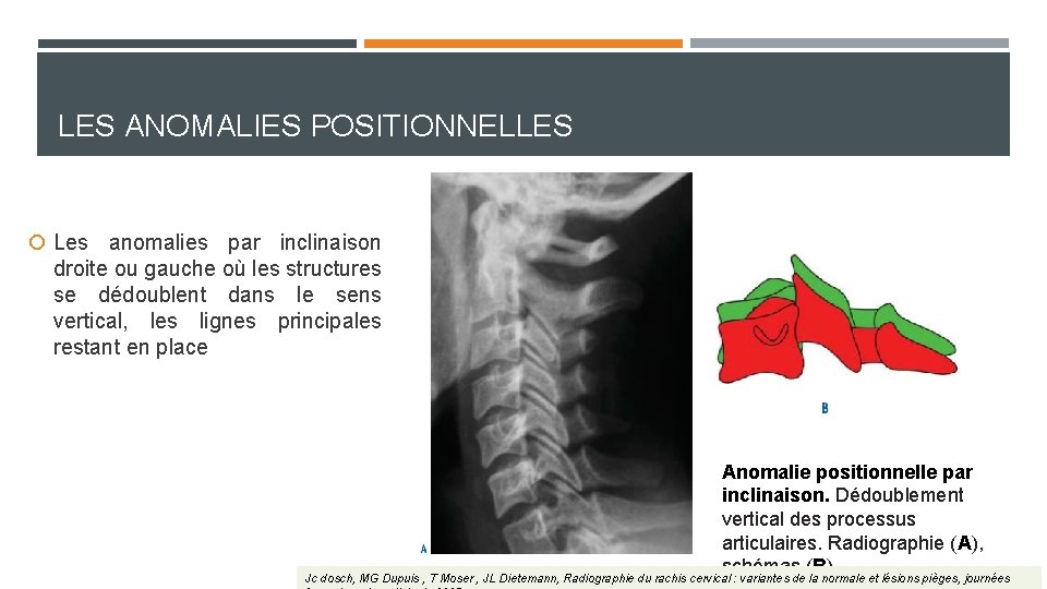 LES ANOMALIES POSITIONNELLES Les anomalies par inclinaison droite ou gauche où les structures se LES ANOMALIES POSITIONNELLES Les anomalies par inclinaison droite ou gauche où les structures se