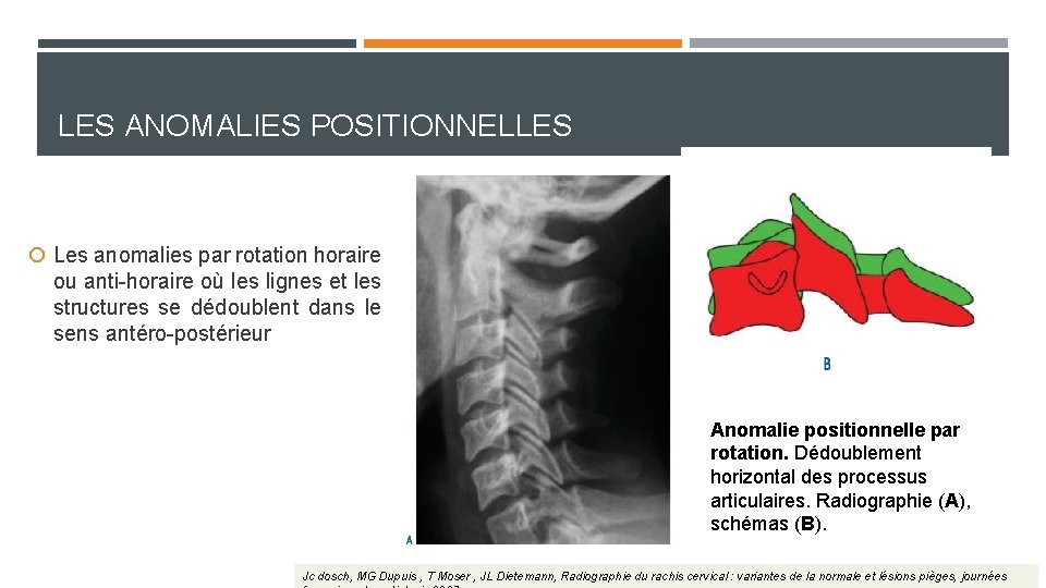 LES ANOMALIES POSITIONNELLES Les anomalies par rotation horaire ou anti-horaire où les lignes et LES ANOMALIES POSITIONNELLES Les anomalies par rotation horaire ou anti-horaire où les lignes et