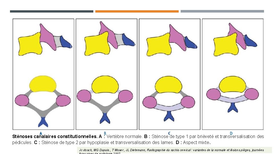 Sténoses canalaires constitutionnelles. A : Vertèbre normale. B : Sténose de type 1 par Sténoses canalaires constitutionnelles. A : Vertèbre normale. B : Sténose de type 1 par