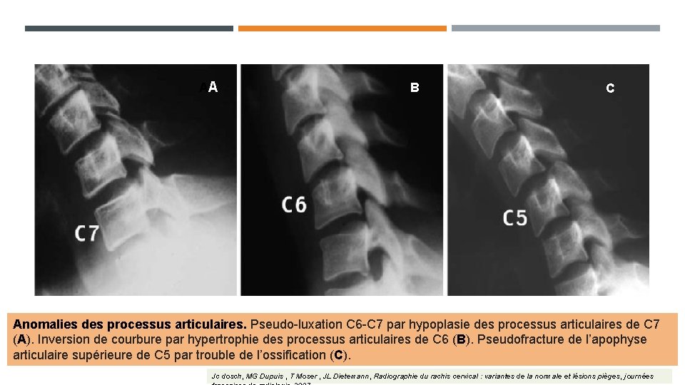AA B C Anomalies des processus articulaires. Pseudo-luxation C 6 -C 7 par hypoplasie AA B C Anomalies des processus articulaires. Pseudo-luxation C 6 -C 7 par hypoplasie