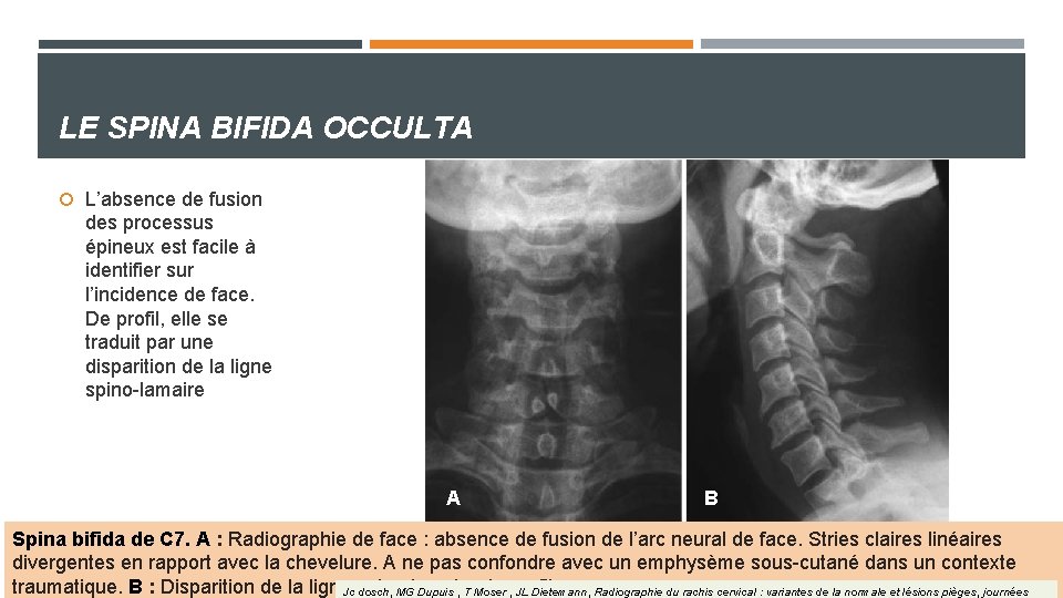 LE SPINA BIFIDA OCCULTA L’absence de fusion des processus épineux est facile à identifier LE SPINA BIFIDA OCCULTA L’absence de fusion des processus épineux est facile à identifier