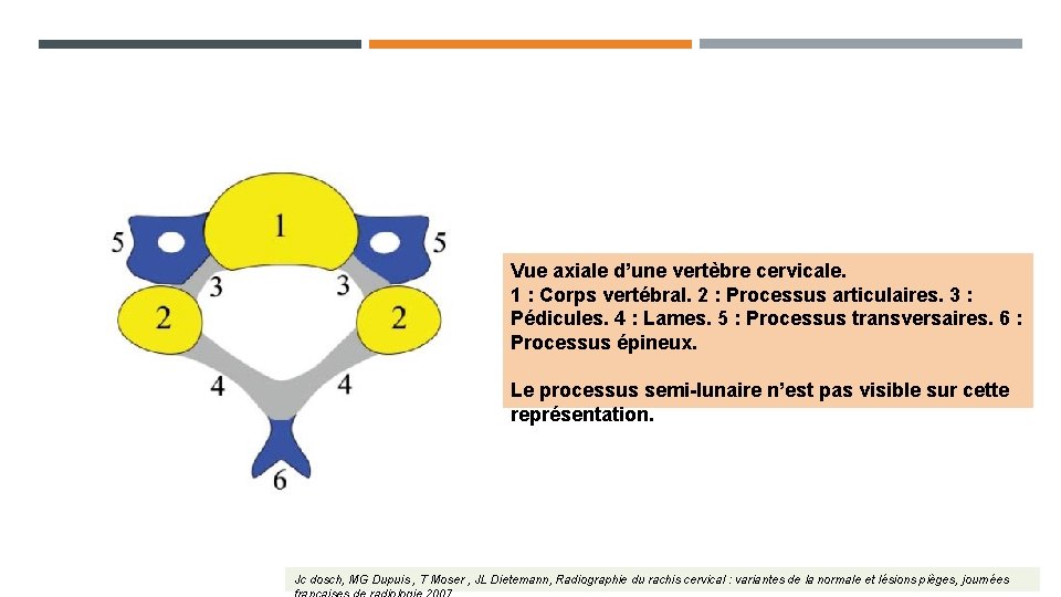 Vue axiale d’une vertèbre cervicale. 1 : Corps vertébral. 2 : Processus articulaires. 3 Vue axiale d’une vertèbre cervicale. 1 : Corps vertébral. 2 : Processus articulaires. 3
