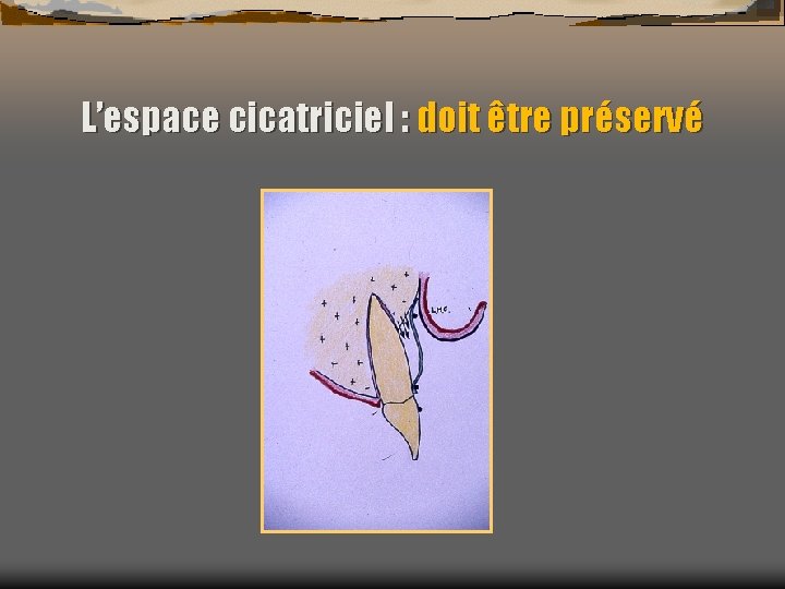 L’espace cicatriciel : doit être préservé 