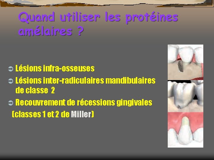 Quand utiliser les protéines amélaires ? Ü Lésions infra-osseuses Ü Lésions inter-radiculaires mandibulaires de