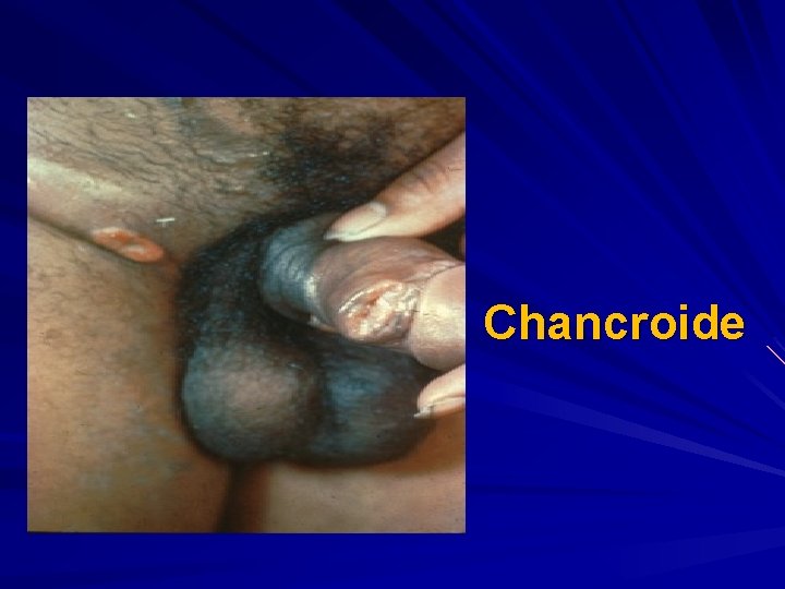 Chancroide 