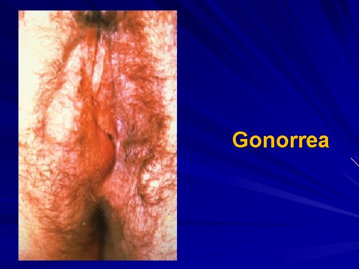 Gonorrea 