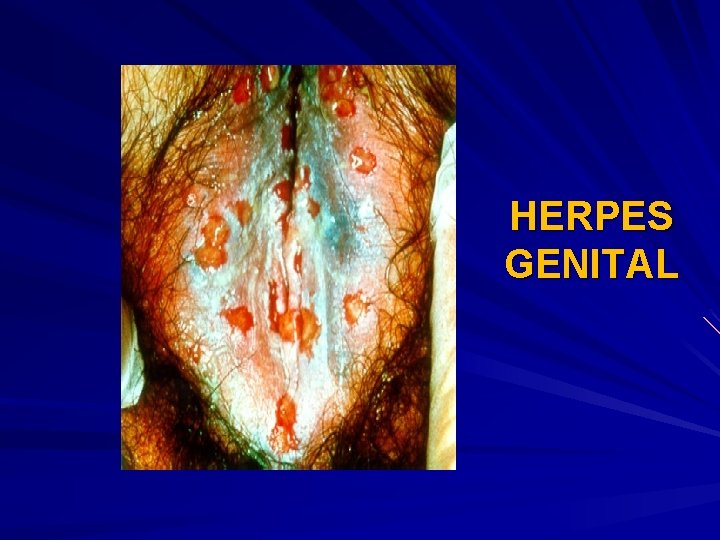 HERPES GENITAL 