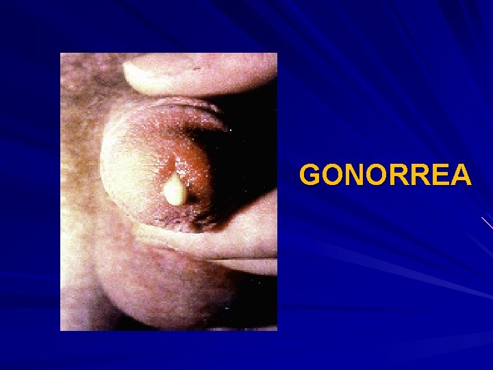 GONORREA 