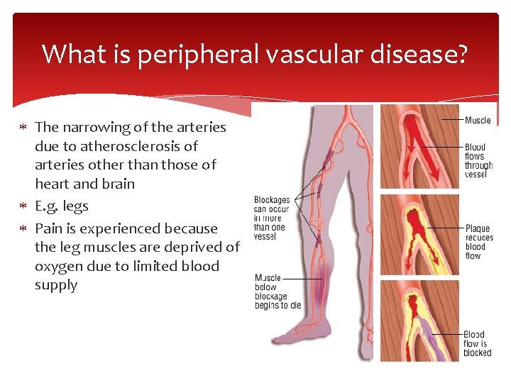 What is peripheral vascular disease? The narrowing of the arteries due to atherosclerosis of
