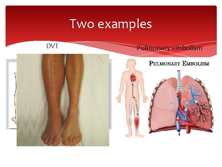 Two examples DVT Pulmonary embolism 