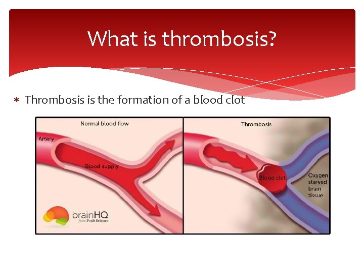 What is thrombosis? Thrombosis is the formation of a blood clot 