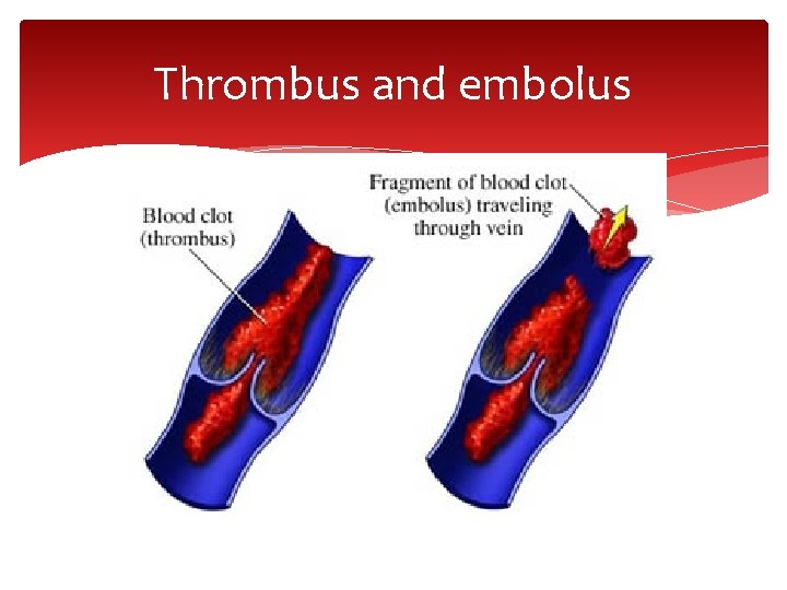 Thrombus and embolus 