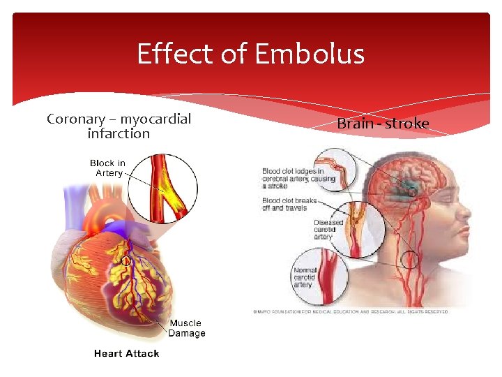 Effect of Embolus Coronary – myocardial infarction Brain - stroke 