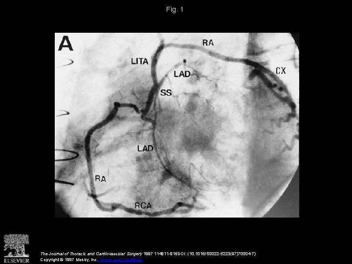 Fig. 1 The Journal of Thoracic and Cardiovascular Surgery 1997 114911 -916 DOI: (10.