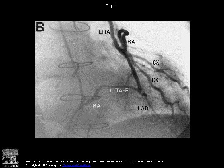 Fig. 1 The Journal of Thoracic and Cardiovascular Surgery 1997 114911 -916 DOI: (10.