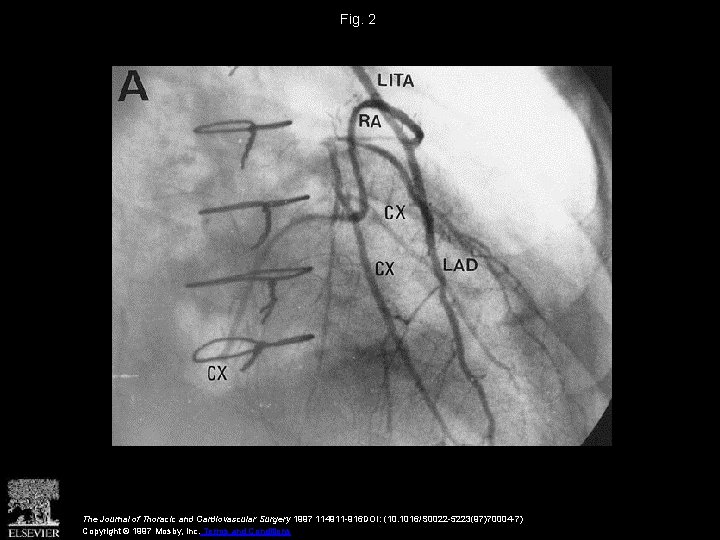 Fig. 2 The Journal of Thoracic and Cardiovascular Surgery 1997 114911 -916 DOI: (10.