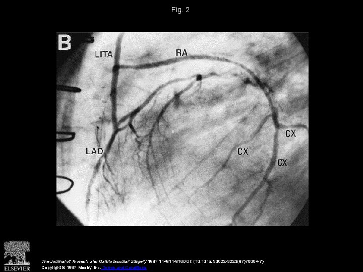 Fig. 2 The Journal of Thoracic and Cardiovascular Surgery 1997 114911 -916 DOI: (10.