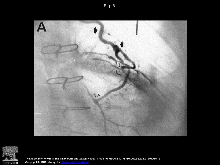 Fig. 3 The Journal of Thoracic and Cardiovascular Surgery 1997 114911 -916 DOI: (10.