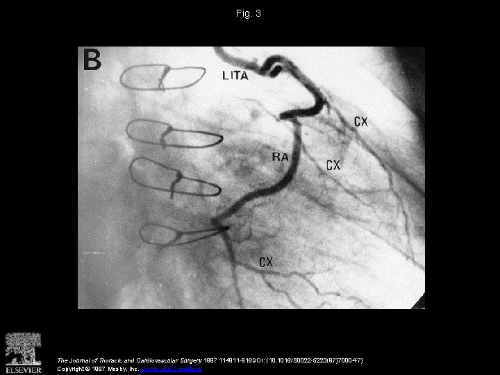 Fig. 3 The Journal of Thoracic and Cardiovascular Surgery 1997 114911 -916 DOI: (10.