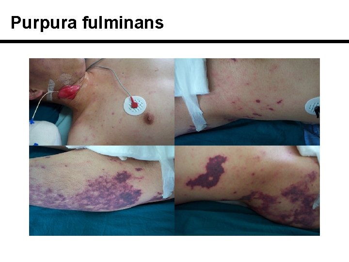 Purpura fulminans 