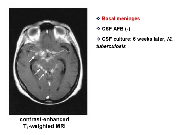 v Basal meninges v CSF AFB (-) v CSF culture: 6 weeks later, M.