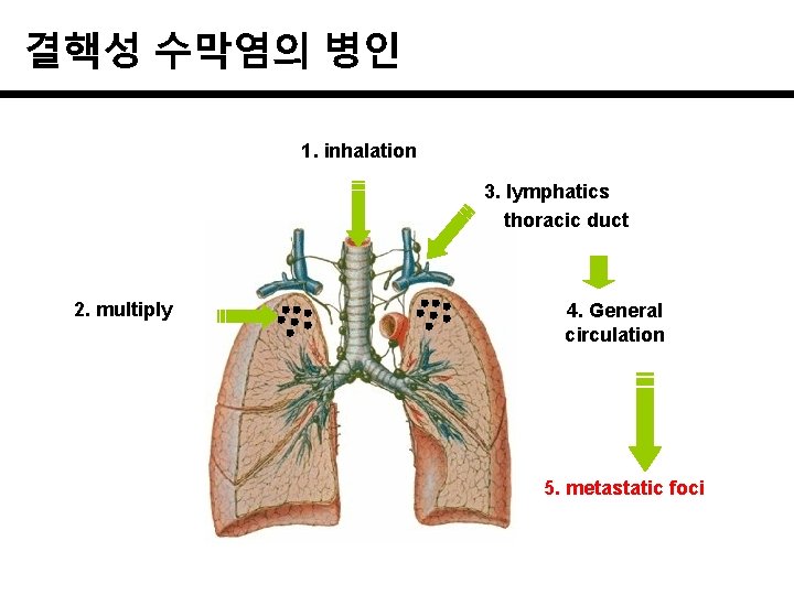 결핵성 수막염의 병인 1. inhalation 3. lymphatics thoracic duct 2. multiply 4. General circulation