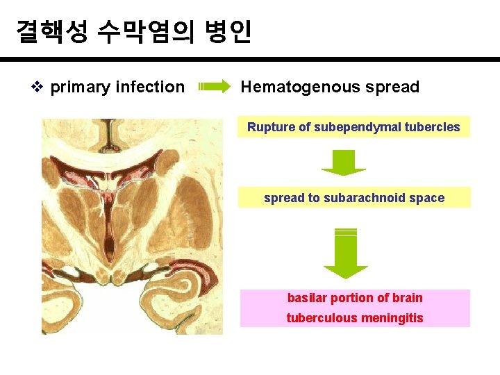 결핵성 수막염의 병인 v primary infection Hematogenous spread Rupture of subependymal tubercles spread to