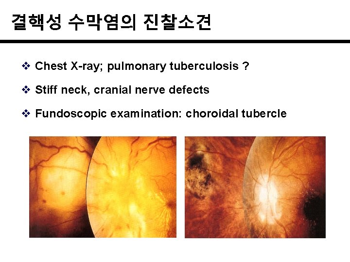 결핵성 수막염의 진찰소견 v Chest X-ray; pulmonary tuberculosis ? v Stiff neck, cranial nerve